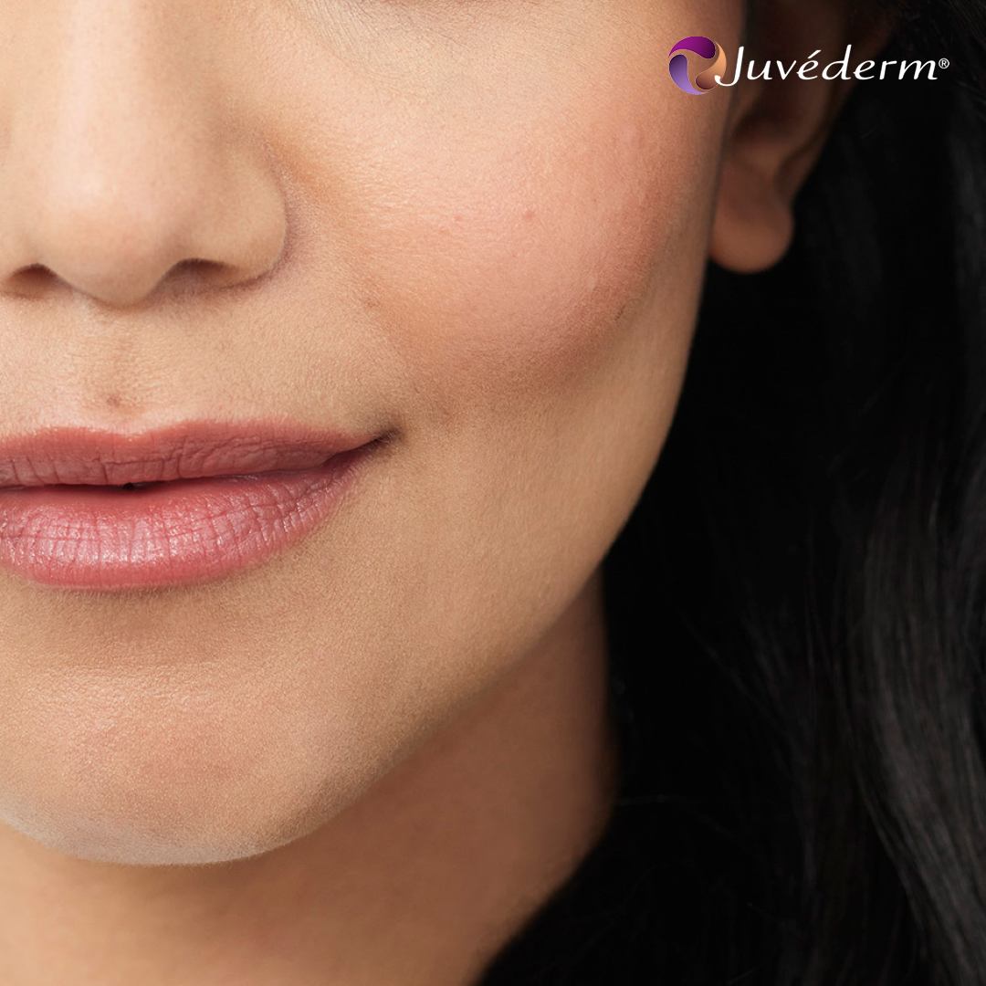 Juvederm fillers läppar